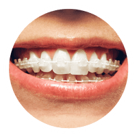 Braces_circle1