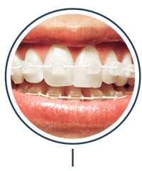 Braces