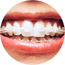 Six Month Smiles Guided Orthodontics for the General Dentist