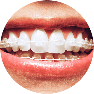 Clear Braces, Invisalign alternative, fast braces alternative, quick straight teeth alternative