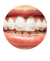 Braces