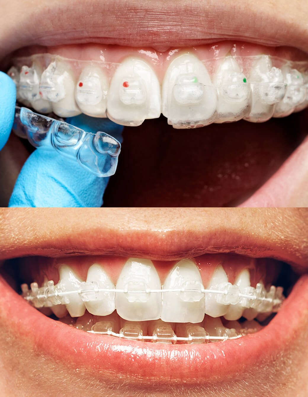 Six Month Smiles