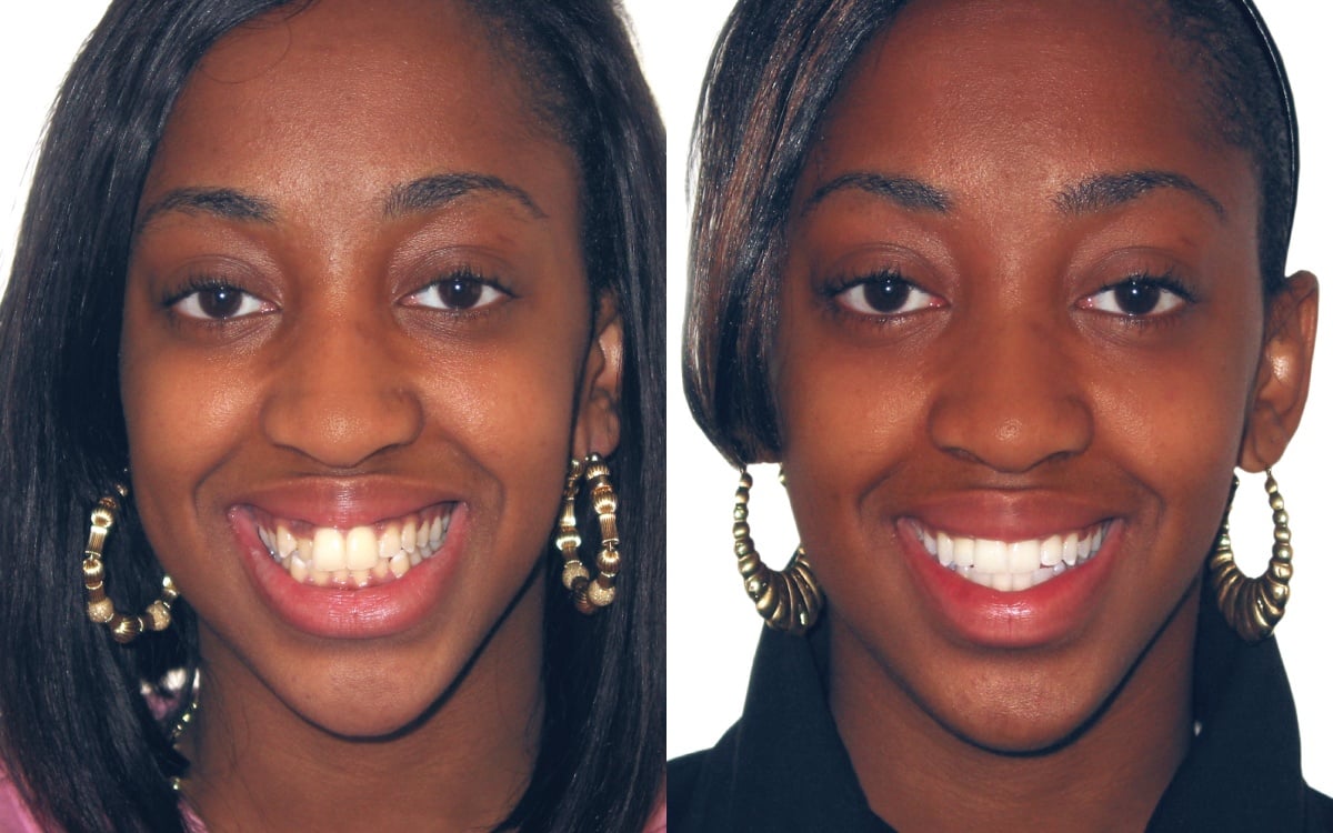 before and after braces adults