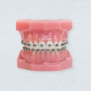 MetalBraces