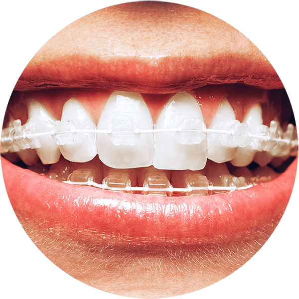 The Facts About How Long Do Braces Last Uncovered