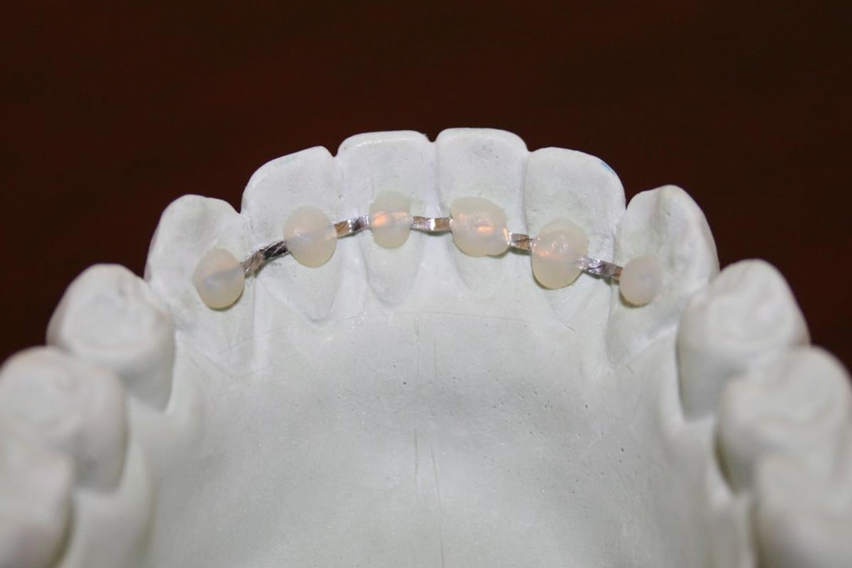 Orthodontic Retention - Lingual Bonded Retainer