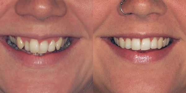 six month smiles straight teeth in less time